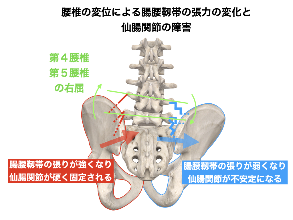 仙腸関節の障害 腸腰靭帯の張力低下による可動性亢進 | にしむら治療院